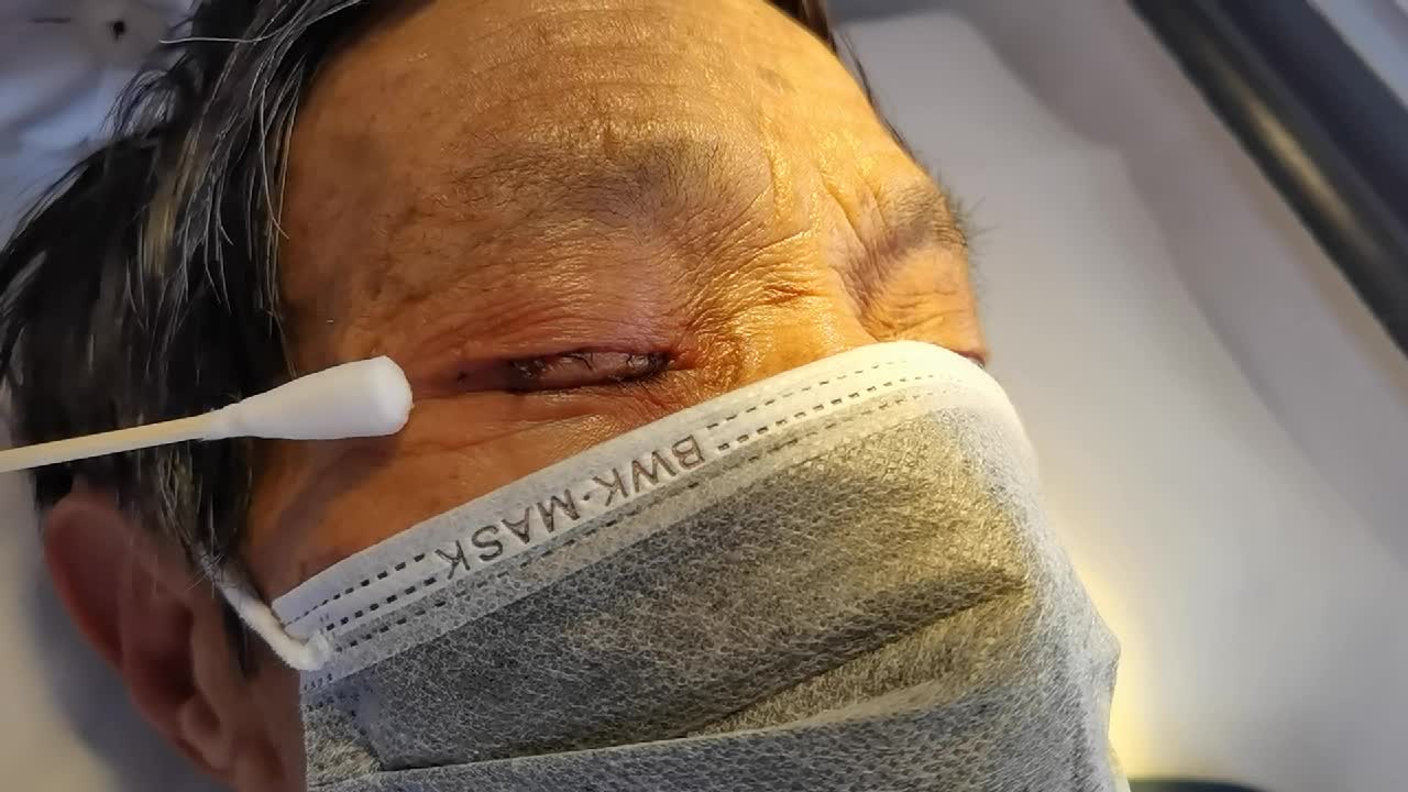 云南省红会眼科常见护理技术规范与流程手册-眼睑拆线